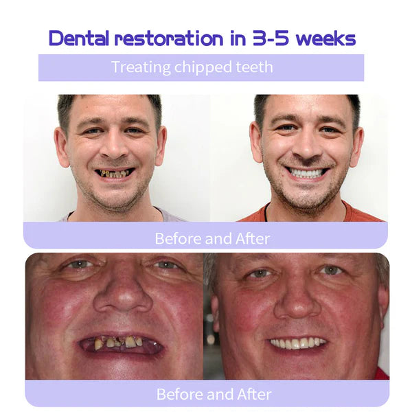 🎁Oferta Flash - ¡No te la pierdas! ODALIT™ Polvo Mineral para Restauración Dental🦷 (Recomendado por TGA)👩‍⚕️ (Trata la periodontitis y las úlceras bucales, previene la pérdida de dientes y repara la recesión de las encías)