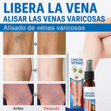 Spray Para Várices - Dale Alivio a tus Piernas + ENVIO GRATIS 🚚